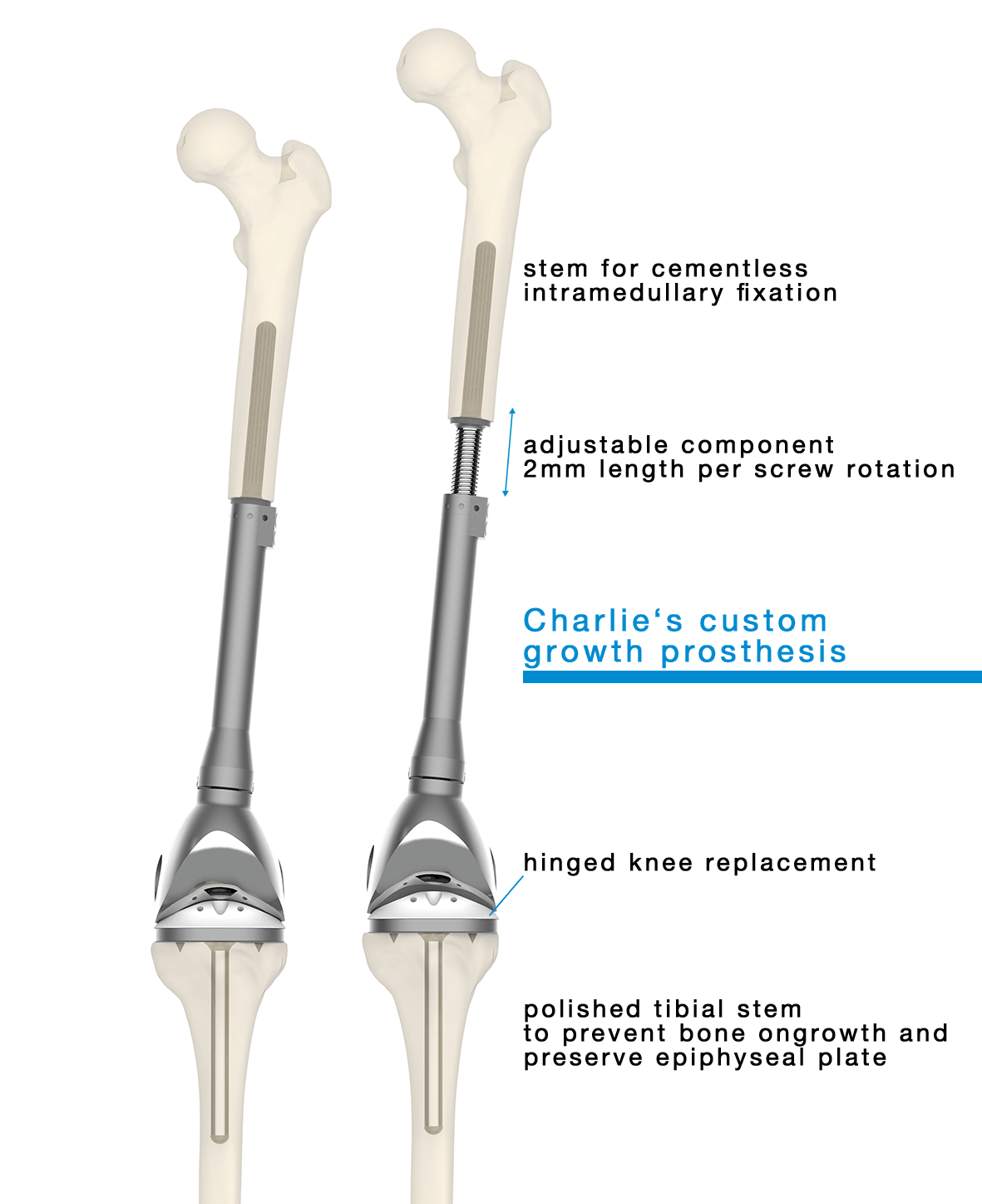 Implant Charlie