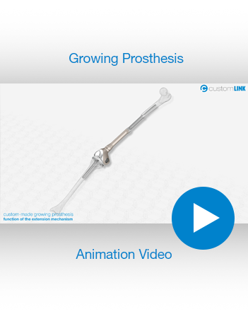 Growing Prosthesis Video